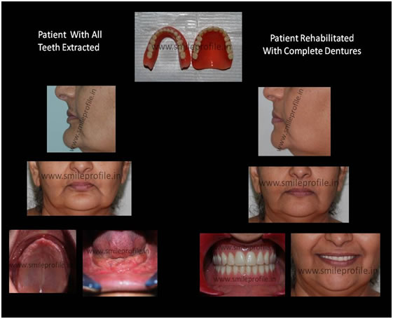complete_dentures