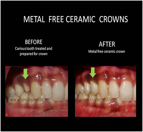 metal_free
