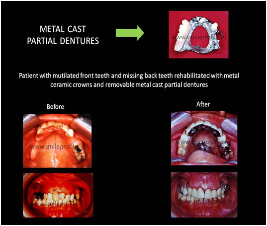 metal_removal